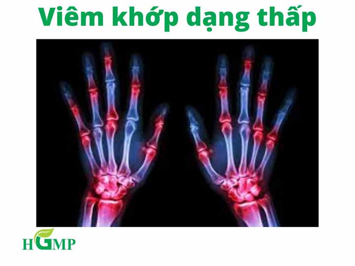 viêm khớp dạng thấp