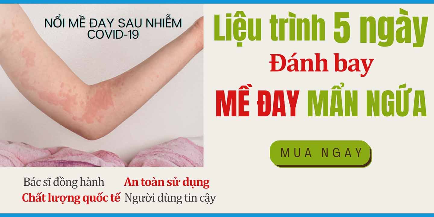 Liệu trình 5 ngày Đánh bay Mề đay Mẩn ngứa