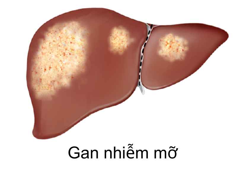 gan nhiễm mỡ