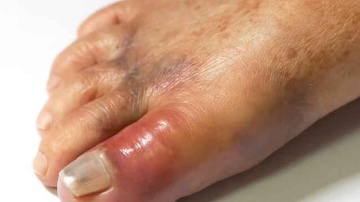 Gout (1)