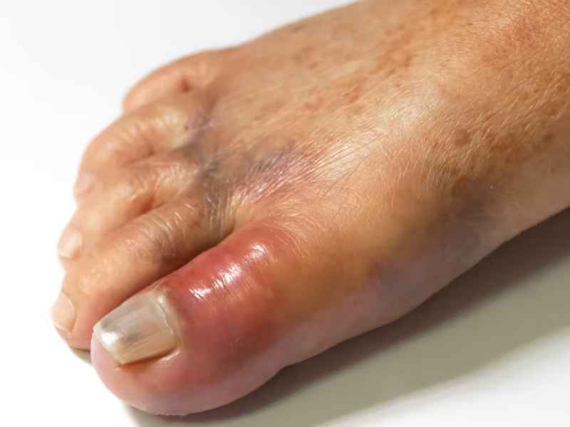 Gout (1)