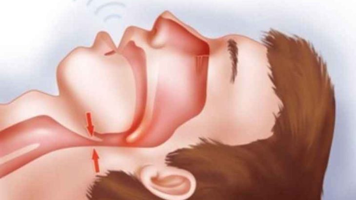 ngưng thở khi ngủ